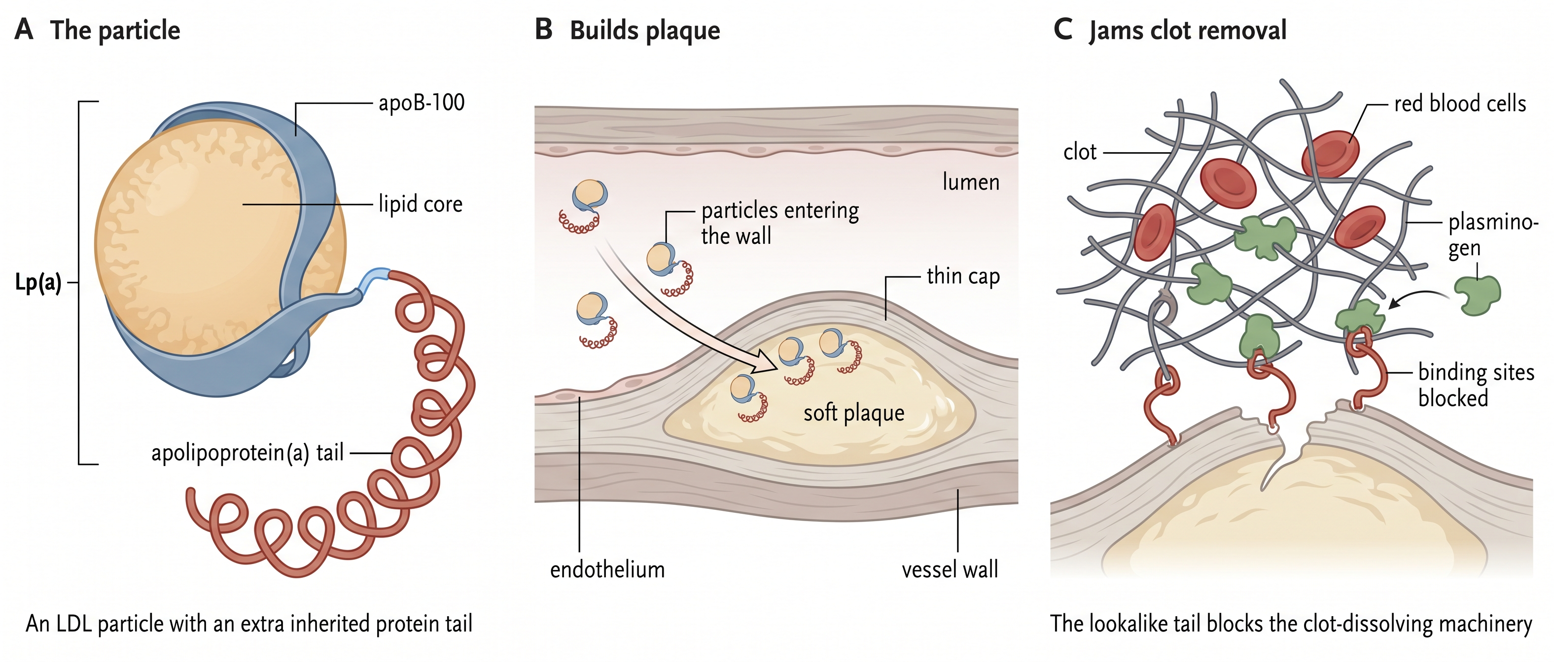 Lp(a) mechanism — A: an LDL particle with an inherited apolipoprotein(a) tail; B: builds soft plaque in the artery wall; C: the lookalike tail blocks clot-dissolving plasminogen